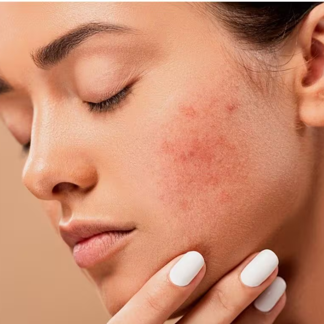 Why You Always Get a Winter Rash and How to Treat Them