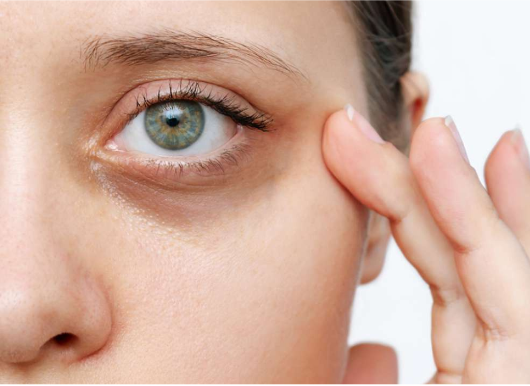 Dark Circles Reasons Under Your Eyes: and How to Remove Them Permanently