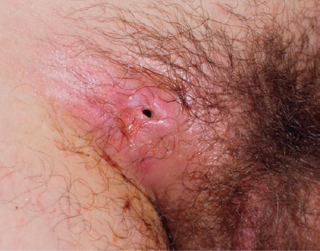 Lymphogranuloma Venereum (LGV): Causes and Treatment